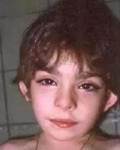 ​关注罕见病——歌舞伎综合征