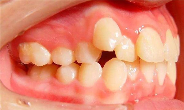 世界上门牙最大的人(牙齿长度达到2.28厘米,宽度达到2cm)(2)_