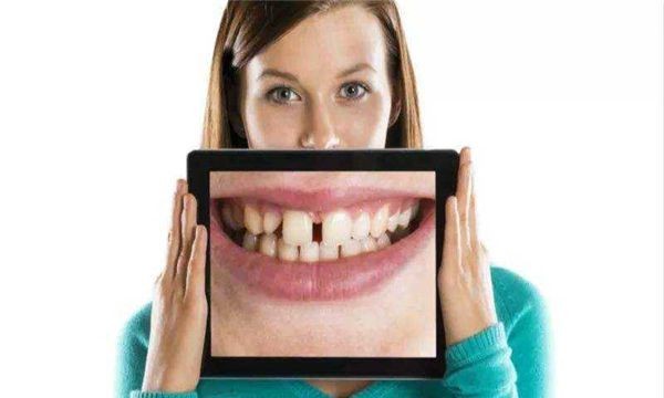 世界上门牙最大的人(牙齿长度达到2.28厘米,宽度达到2cm)(3)_